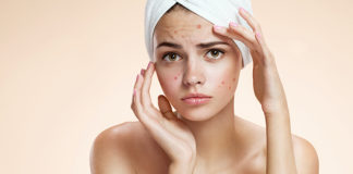 Mituri legate de acnee